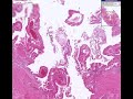 Histopathology Gallbladder--Acute cholecystitis Histopathology Gallbladder--Acute cholecystitis