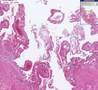 Histopathology Gallbladder--Acute cholecystitis