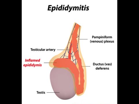 how to relieve epididymitis