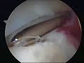 SLAP lesion typeII ???????? ??????????? ???????????????????? SLAP lesion typeII ???????? ??????????? ????????????????????