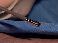 PERCUTANEOUS Back-pain therapy, surgical video