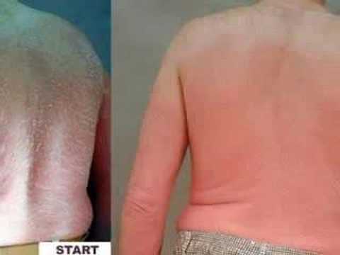 how to relieve psoriasis itching