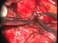 Trigeminal Schwannoma