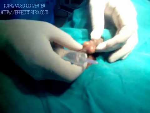 how to drain testicular cyst