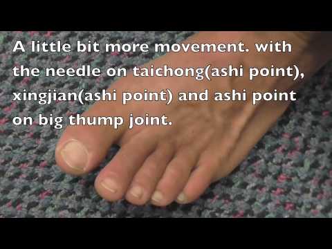 how to treat gout in a toe