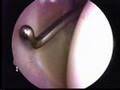 Arthroscopy: Inside the Shoulder by Ford Qureshi