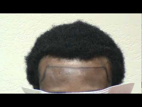 how to cure receding hairline