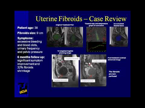 how to treat uterine fibroids