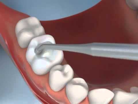 how to whiten composite fillings