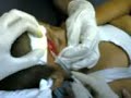 NURSING: Head Wound