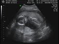 Villeret Baby Boy 5