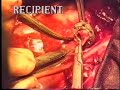 Vascular stapler in experimental lung transplant
