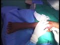 Application of Rail Fixator for Non Union Part 1