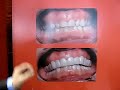 Snap on Smile Snap on Smile