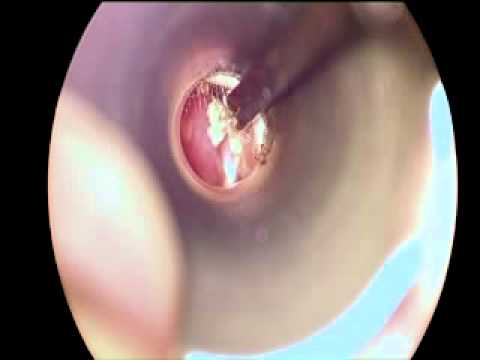 how to unclog ear with cigarette