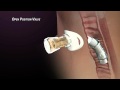 Passy-Muir Valve Design