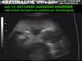 GRAVIMAGEM 56 (ultra-som gravidez 19 semanas 3d 4d) GRAVIMAGEM 56 (ultra-som gravidez 19 semanas 3d 4d)