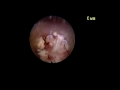 Endoskopik disk ameliyatı