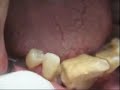 Advanced Periodontal Disease Loose Tooth