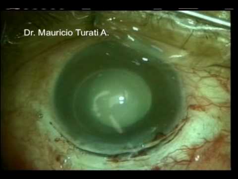 how to control glaucoma