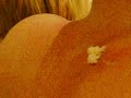 This is a example of the true love I have for my boyfriend! Its a vid of me squeezing the puss out of my boyfriends back (which has to be done on a regualr basis i might add!) . Its never ending with an eruption part way through and it frikken stinks!!! Enjoy and vomit as you please !!!