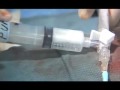 Live Uterine Fibroid Embrolization Surgery