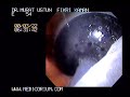 İntragastrik Balon - Mide Balonu (Intragastric Baloon)