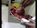 Renal cell carcinoma of lolo emong Renal Cell Cancer