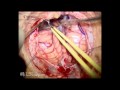 Pineal tumor surgery - subtentorial supracerebellar approach