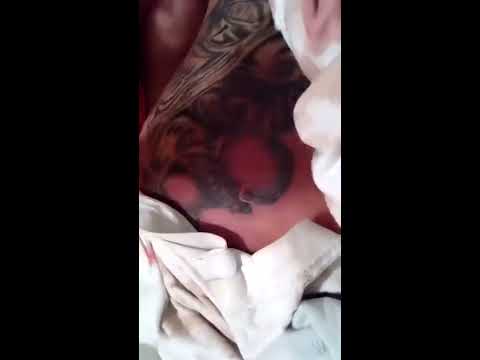 Gnarly Tattoo Infection