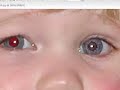 Alternative Photoshop Red Eye Removal Alternative Photoshop Red Eye Removal