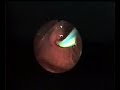 WORM EXTRACTION FROM BILE DUCTS