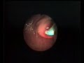 WORM EXTRACTION FROM BILE DUCTS Tapeworm Infection