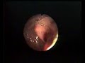 WORM EXTRACTION FROM BILE DUCTS