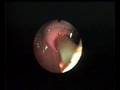 WORM EXTRACTION FROM BILE DUCTS
