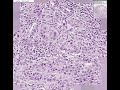 Histopathology Skin--Squamous cell carcinoma
