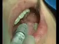 3rd molar ext