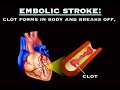Ischemic Strokes (Health Tip) Ischemic Strokes (Health Tip)