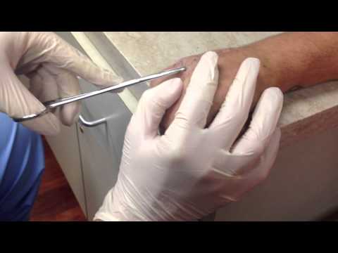 how to remove k wires