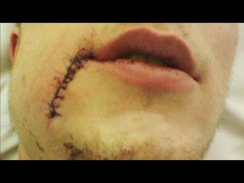 Injury - HC Plzen forward Tomas Pitule will do anything for his team, including blocking shots. Unfortunately his will an passion to win resulted in 78 stitches, 60 i...