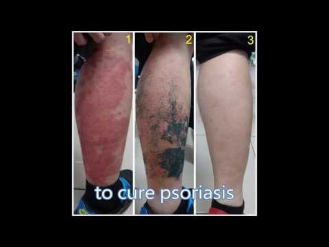 how to apply cmc ointment