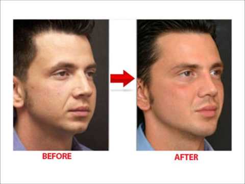 how to get rid cheek fat