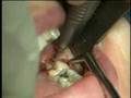 extraction dent de sagesse inferieure