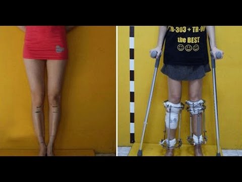 how to treat broken toe