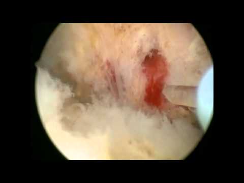 how to relieve urinary retention after surgery