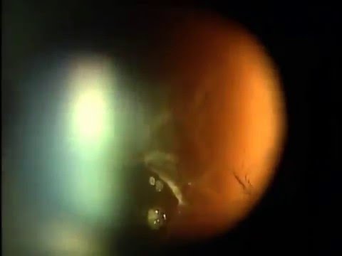 Видео Витреолизис