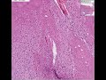 Histopathology Brainstem--Glioma Histopathology Brainstem--Glioma