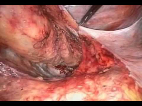 Colon Surgery - Authors: J Leroy; M K Smith; F Rubino; J Marescaux.