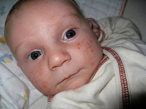 how to help baby acne