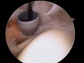 Arthroscopic shoulder surgery for the treatment of rotator cuff tears: Diagnostic arthroscopy